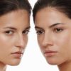 Rhinoplasty – Nasal corrective surgery (whole nose for 2550€) by Plastic and Aesthetic Surgery Hospital “SkinSystems”! 