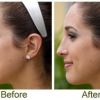 Rhinoplasty – Nasal corrective surgery (whole nose for 2550€) by Plastic and Aesthetic Surgery Hospital “SkinSystems”! 